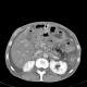 Venous congestion, thrombosis of superior mesenteric vein, ascites, steatosis of liver: CT - Computed tomography